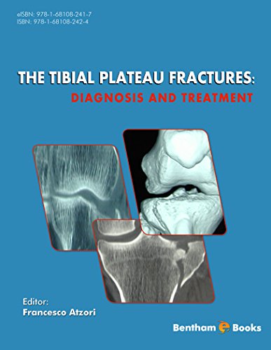 The Tibial Plateau Fractures: Diagnosis and Treatment (English Edition)